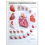 Poster 3D de Doenças Cardiovasculares em Alto-Relevo