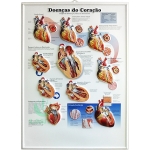 Poster 3D Doenças do Coração em Alto-Relevo.