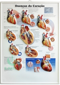 Pôster 3D Doenças do Coração em Alto-Relevo.og:image